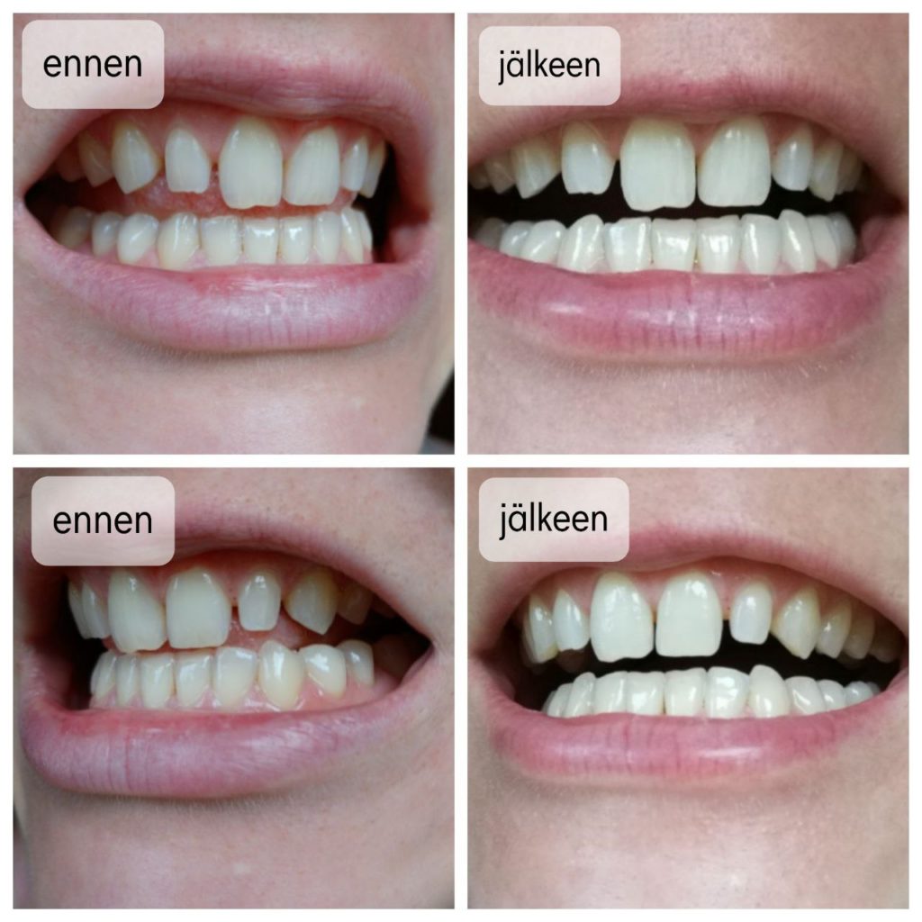 Smileo hampaiden valkaisusetti täyttöpakkaus kokemuksia