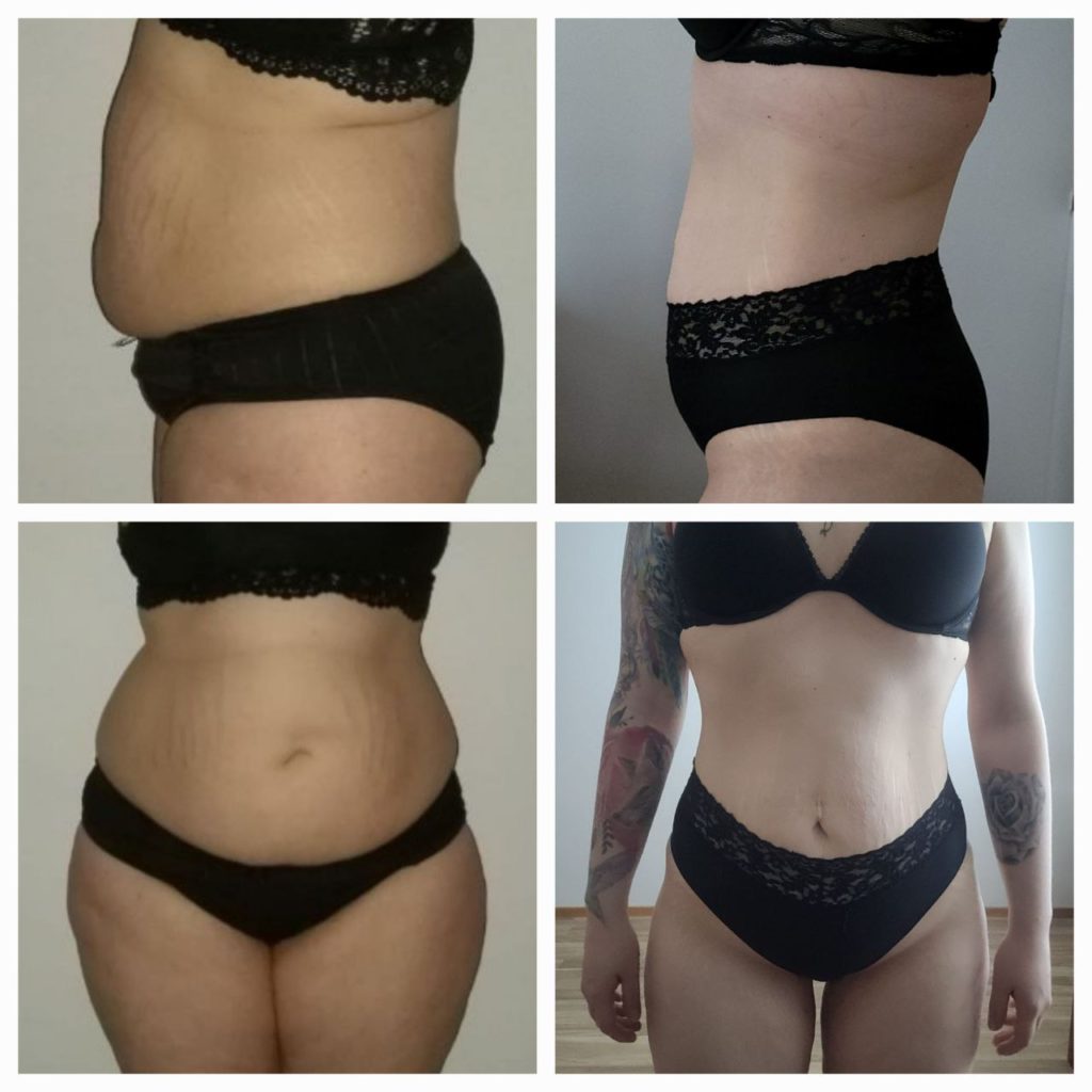 25 kilon painonpudotus 10 kuukaudessa ennen ja jälkeen kuvat